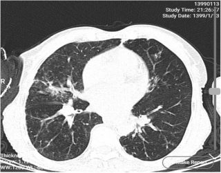 آلودگی همزمان کرونا ویروس و انفولانزا در یک فرد متوفی